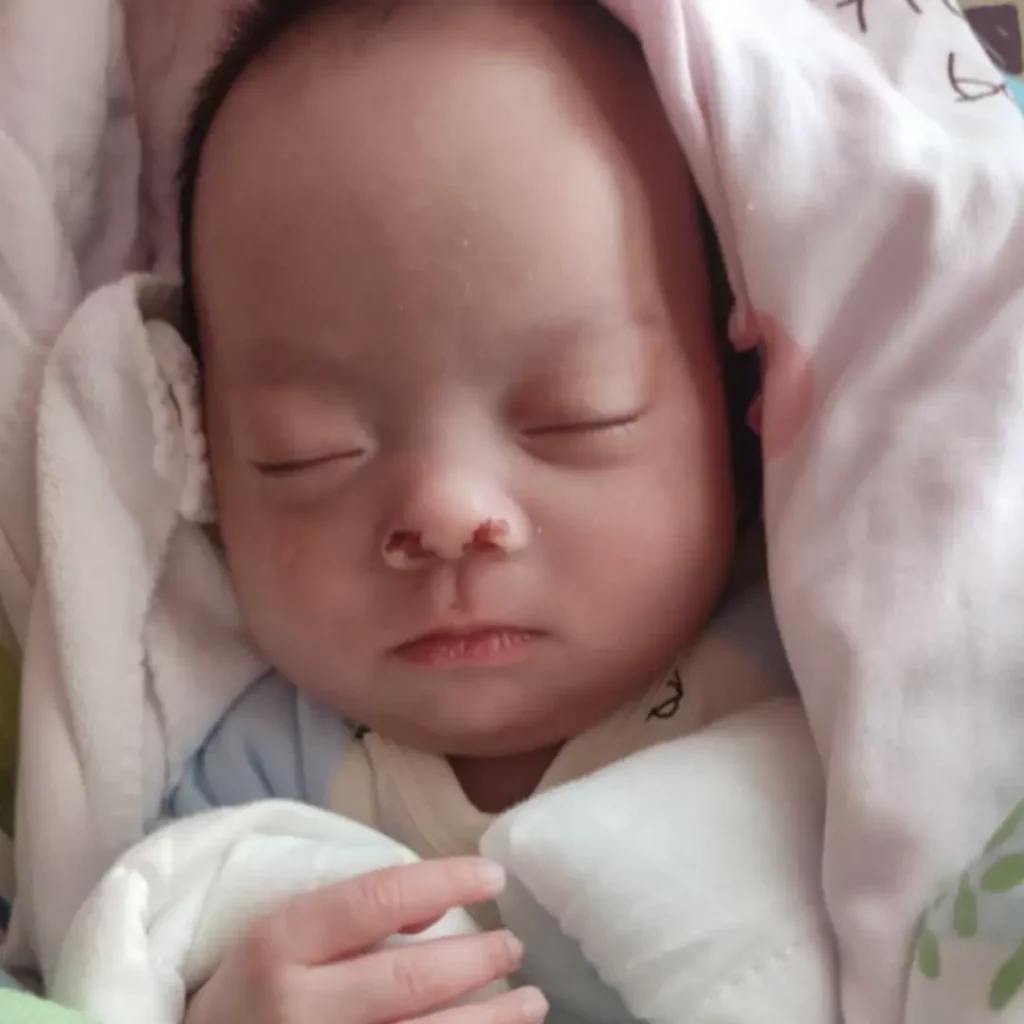 Yi Ling as a small preemie.